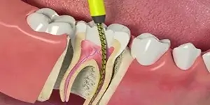 root-canal